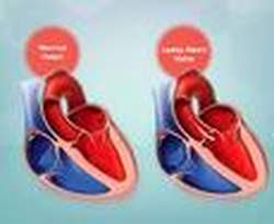 Leaky Heart Valve