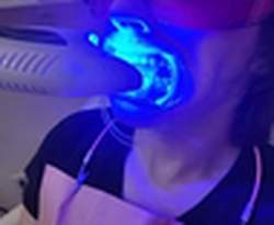 Ur Bryte Smile Teeth Whitening